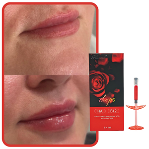 Produit OEM d'usine : Remplisseur pour lèvres rouges 1ml – Crée des lèvres pulpeuses, améliore l'éclat des lèvres – <span class=keywords><strong>Injection</strong></span> de remplissage à l'<span class=keywords><strong>acide</strong></span> <span class=keywords><strong>hyaluronique</strong></span> - Product Image 1