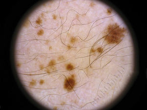 IBOOLO DE-4100 appareil de <span class=keywords><strong>dermatoscope</strong></span> photo pour dermatologie <span class=keywords><strong>dermatoscope</strong></span> polarisé smartphone Dermoscope - Product Image 4