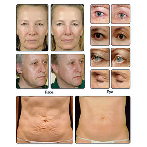 <span class=keywords><strong>SVATAR</strong></span> Máquina de Cavitación de 40Khz con 5 Manijas, Vacío y Radiofrecuencia para Reducción de Grasa y Adelgazamiento Corporal - Product Image 5