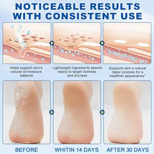 Oem 60% urê kem dính cộng với 2% salicylic axit urê kem chân Callus Remover Tẩy Tế Bào Chết Kem dưỡng ẩm dưỡng ẩm - Product Image 4