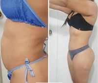 Machine de fusion de graisse de liposuccion assistée par puissance canules de lipolyse laser à fibre de retrait de graisse de chirurgien cosmétique approuvé CE