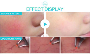 Mesin Laser 980nm untuk Penghapusan Varises dan Onikomikosis - Product Image 4