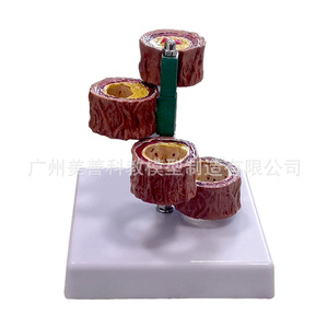 Modèle vasculaire humain ; vaisseaux sanguins/occlusion ; vaisseaux sanguins chez les personnes âgées ; embolie/blocage/modèle ; modèle vasculaire/PATHOLOGIQUE - Product Image 2