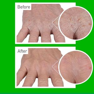 <span class=keywords><strong>Crema</strong></span> <span class=keywords><strong>Facial</strong></span> Vegana y Libre de Sulfatos <span class=keywords><strong>para</strong></span> Alivio de la Piel, <span class=keywords><strong>Eczema</strong></span>, Prurito y Hongos, Efecto Potente, Libre de Crueldad Animal, Marca Privada OEM/ODM - Product Image 2