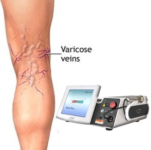 Migliore 1470 diodo 980nm Evlt <span class=keywords><strong>vene</strong></span> Varicose Laser per endovenosa ablazione termica con terapia Laser per le <span class=keywords><strong>vene</strong></span> Varicose delle gambe - Product Image 4
