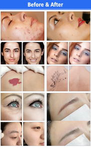 Machine de beauté pour l'élimination des tatouages au laser Pico Nd Yag Q-Switched 1064nm 532nm 755nm - Product Image 5