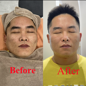 Microneedling Naturale Bio con Spugne Marine per Rimozione di Punti Neri, Acne e Pigmentazione, Peeling con Alghe e Spicole di Spongilla - Product Image 3