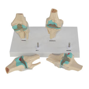 Modèle d'articulation du genou en science médicale, ensemble d'arthrose à 4 étapes, articulation du genou pour le bureau des médecins, outil éducatif - Product Image 4