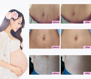 Crème pour éliminer les vergetures <span class=keywords><strong>et</strong></span> la <span class=keywords><strong>cellulite</strong></span> du ventre, pour le traitement des cicatrices - Product Image 4