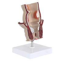 KyrenMed Modèle d'hémorroïde interne externe rectale humaine Modèle pathologique anorectal Modèle de lésion de fissure du rectum Taille réelle