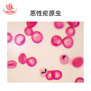 Portaobjetos con preparado de Plasmodium vivax, patología, diflujo sanguíneo, parásito médico, película sanguínea gruesa y fina, coloración con Giemsa. - Product Image 4