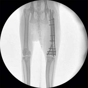 آلة تنظير الذراع PFD C لجراحة الأشعة مع نظام ذراع رقمي C جهاز أشعة <span class=keywords><strong>X</strong></span> - Product Image 6