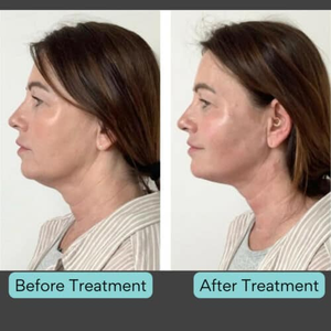 Promosi Pabrik China Mesin Laser Endolifting <span class=keywords><strong>1470nm</strong></span> 635nm untuk Pengangkatan Varises dan Penghapusan Vena - Product Image 5