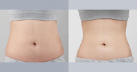 Machine de lipolyse laser la plus efficace 980nm1470nm, liposuccion chirurgicale, endolaser, lifting facial