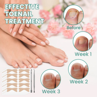 Autocollant de correction des ongles incarnés, doux, confortable, respirant, sûr à utiliser, améliore l'aspect des ongles incarnés