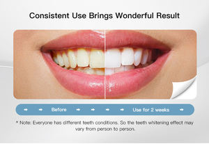 Lampe de <span class=keywords><strong>blanchiment</strong></span> <span class=keywords><strong>dentaire</strong></span> Vente en gros tache jaune Enlever le sourire blanc brillant <span class=keywords><strong>Kit</strong></span> de <span class=keywords><strong>blanchiment</strong></span> des dents professionnel à lumière LED pour la maison - Product Image 4