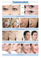 Nettoyage en profondeur à haute pression, jet d'eau oxygénée, peeling de la peau, rajeunissement, blanchiment, pulvérisateur, jet de peeling de la peau, injecteur hydro