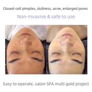 Suero Crema Esencial de Microagujas Rosa OEM para Tensar y Reducir Poros en Medicina Estética y Belleza - Product Image 4