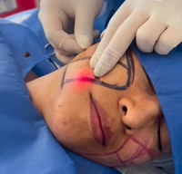 Endo Laser Lifting du visage 980nm + 1470nm Vaser Liposuccion Perte de poids Endolaser Machine de serrage de la peau