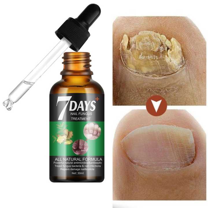 MOOYAM 7 Days Nail Fungus Treatment Serum - Natural Plant Formula to ...