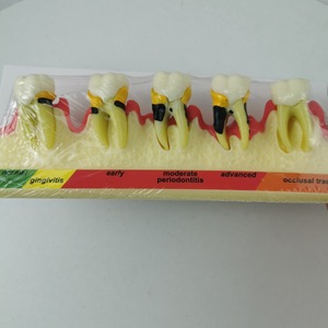 Modèle dentaire de classification parodontale M4010, modèle anatomique en silicone médical pour l'enseignement dentaire - Product Image 4