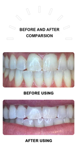 GlorySmile Kit di sbiancamento dei denti con perossido o Non perossido di denti gel sbiancanti all'interno di un Kit di sbiancamento dei denti a buon mercato etichetta privata - Product Image 6