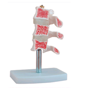 Humanos osteoporóticas <span class=keywords><strong>esqueleto</strong></span> óseo anatómico modelo - Product Image 1