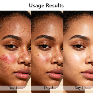 <span class=keywords><strong>Crema</strong></span> Anti-Acne SUNRANA, Trattamento Professionale per <span class=keywords><strong>Pelle</strong></span> <span class=keywords><strong>Grassa</strong></span>, Rimozione Acne - Product Image 2