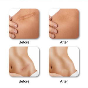 ครีมซ่อมแซมรอย<span class=keywords><strong>แผล</strong></span>เป็นสำหรับรอยแผลเป็นใหม่และเก่า ช่วยให้แผลเป็นจากน้ำร้อนลวก รอยแผลเป็นจากการ<span class=keywords><strong>ล้ม</strong></span> และรอย<span class=keywords><strong>แผล</strong></span>เป็นจากการผ่าคลอด - Product Image 5