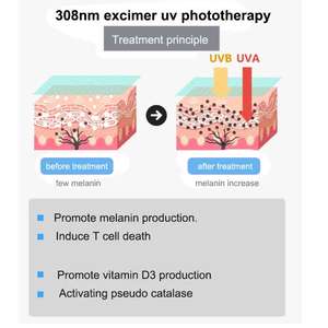 Potente Mini 308nm Excimer Laser System Nueva tendencia Lámpara de fototerapia de luz médica 311nm <span class=keywords><strong>UVB</strong></span> para equipo de fisioterapia - Product Image 6