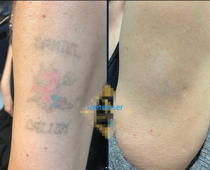 Pico laser Q Switched ND Yag laser picosecond Laser loại bỏ hình xăm máy - Product Image 6