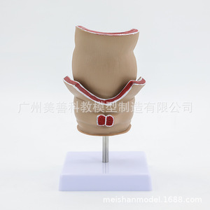 Modèle de hémorroïdes rectales et de lésions colorectales ; hémorroïdes rectales internes et externes et modèle anorectal ; pathologie rectale. - Product Image 4