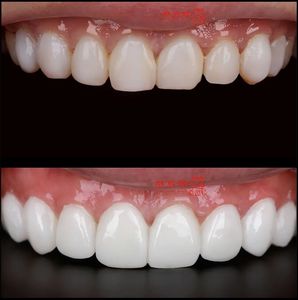 Lapisan porselen yang sangat indah dibuat dengan pengecoran dengan kekuatan tinggi dan terlihat alami dari China <span class=keywords><strong>Dental</strong></span> Lab - Product Image 2
