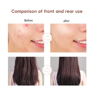 Varita de Belleza Facial 4 en 1, Terapia de Electrodos para el Tratamiento del Acné, Ozono, Máquina Facial Portátil de Alta Frecuencia - Product Image 3