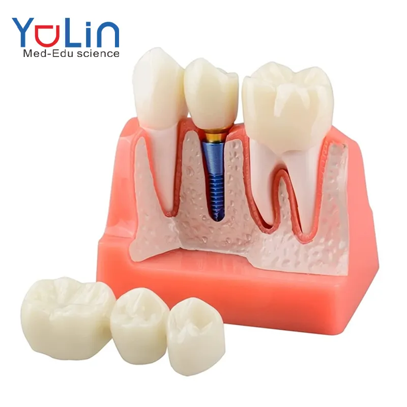 Импланты модель для обучения пациентов в 4 раза импланты с короной и мост Модель для презентации-розовый