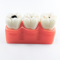 Modèle anatomique détachable 4x agrandi pour l'éducation et l'enseignement sur les caries dentaires, usage en soins bucco-dentaires, CE/ISO