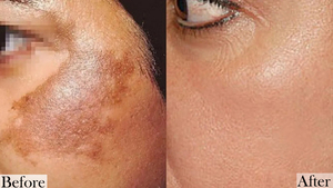 Máquina Láser Nd:YAG Q-Switch para Eliminación de Tatuajes Quirúrgica Estacionaria con Peeling de Carbono y Pulso Largo para Cirugía Plástica - Product Image 6