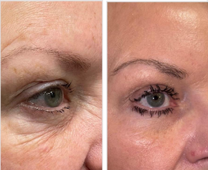 Appareil de thérapie faciale au laser fractionné au CO2 en dermatologie pour remodeler la peau, laser fractionné pour éliminer les rides, élimination des vergetures - Product Image 5