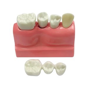Modèle d'implant dentaire 4-en-1 avec couronne amovible, pont dentaire et facettes en porcelaine pour l'étude et la démonstration pédagogique - Product Image 5
