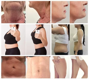 Máquina de Adelgazamiento por Criolipólisis, Congelación de Grasa, Cavitación 40K, 6+2 LipoLaser, Radiofrecuencia, Lifting Facial, Equipo de Belleza para Salón - Product Image 6