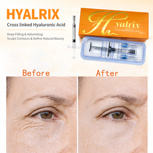 Hyalrix Professional, acide hyaluronique, produit de comblement dermique pour le remodelage des lèvres, les soins des rides du visage et les applications esthétiques. - Product Image 3