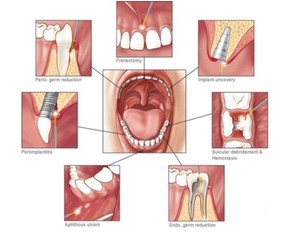 Máquina Láser Diodo Dental Portátil de 980nm para Blanqueamiento Dental con Láser de Tejido Blando - Product Image 2