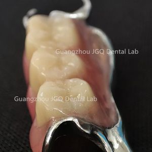 Prothèses dentaires amovibles avec cadre métallique en alliage de cobalt-chrome bonne biocompatibilité pour les humains de laboratoire dentaire de Chine prix bon marché - Product Image 5