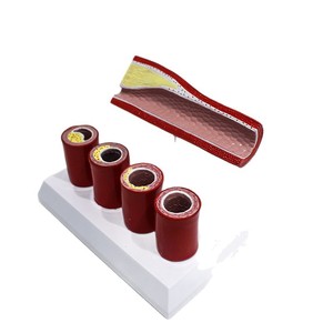 Modelo anatómico cardiovascular; estructura del trombo de la aterosclerosis de las arterias coronarias; muestra de demostración para el aula de medicina. - Product Image 5