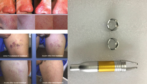 Dispositivo Laser 2026 per Rimozione Vasi Sanguigni 980nm, Liposuzione 1470nm, Rimozione Doppio Mento/Borse Sotto gli Occhi, Lifting Viso, Endolaser per Dimagrimento - Product Image 3