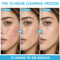 Gel personnalisable pour cicatrices d'acné à l'acide salicylique, cellules souches de saumon, acide hyaluronique, centella, minimiseur de pores, nourrissant, éclaircissant, OEM
