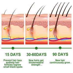 Solution de croissance des cheveux au romarin Anti-chute de cheveux Soin nourrissant pour le cuir chevelu Huile essentielle - Product Image 4