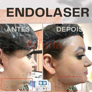 600un 400um الألياف Endolaser للوجه والجسم تحلل الدهون شفط الدهون الألياف الدهون تقليل الدهون - Product Image 6