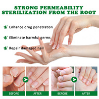 Soin Réparateur Herbal 7 Jours Contre les Mycoses des Ongles – Sérum Essentiel pour les Pieds, Gel Anti-Infection pour l'Élimination des Mycoses des Ongles des Orteils, Traitement de l'Onychomycose