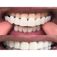 Nouvelles prothèses dentaires supérieures et inférieures Snap Smile, couvre-dents pour un sourire parfait, placages confortables et flexibles, blanchiment des dents
